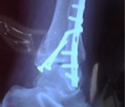 Crash's Ankle