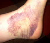 Fresh Meat Kelly's Ankle