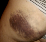 Goody To Bruise Bum