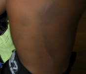 Lulu's run over leg