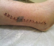 Nightmare's Ankle